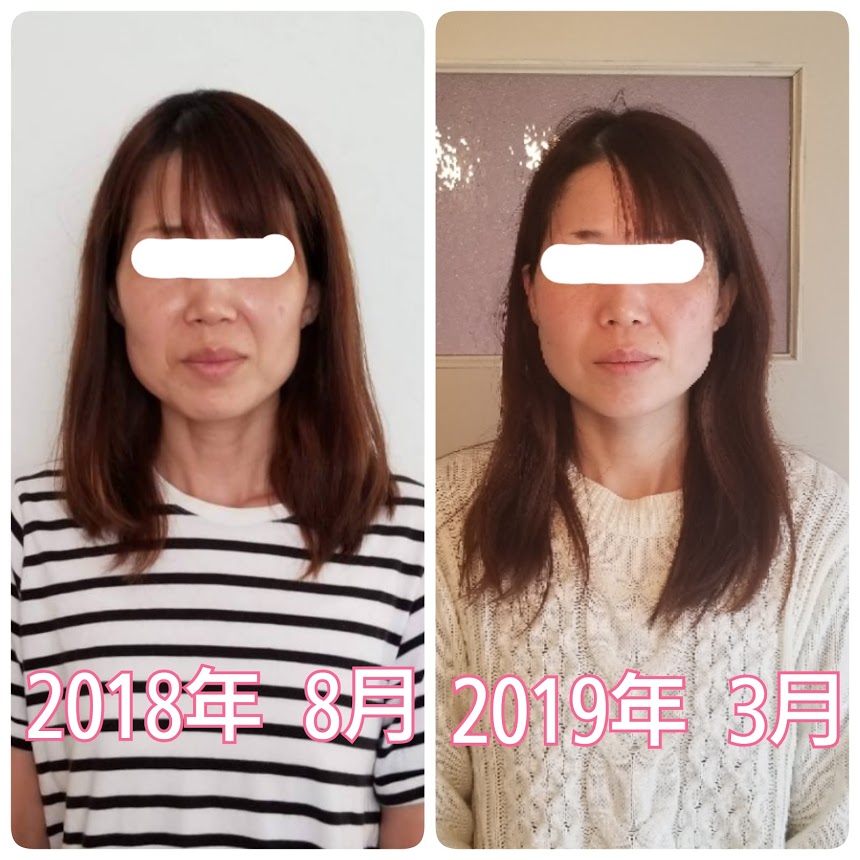 半年後のお顔の変化 30代 愛知県半田市の小顔矯正 小顔エステサロン 潜在意識カウンセリングはブルーム